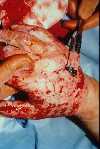 Excision and Skin Grafting 1.
