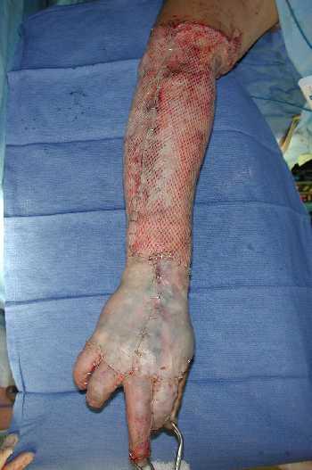 Split Thickness Skin Graft Epidermis and partial thickness of dermis Transplant to viable