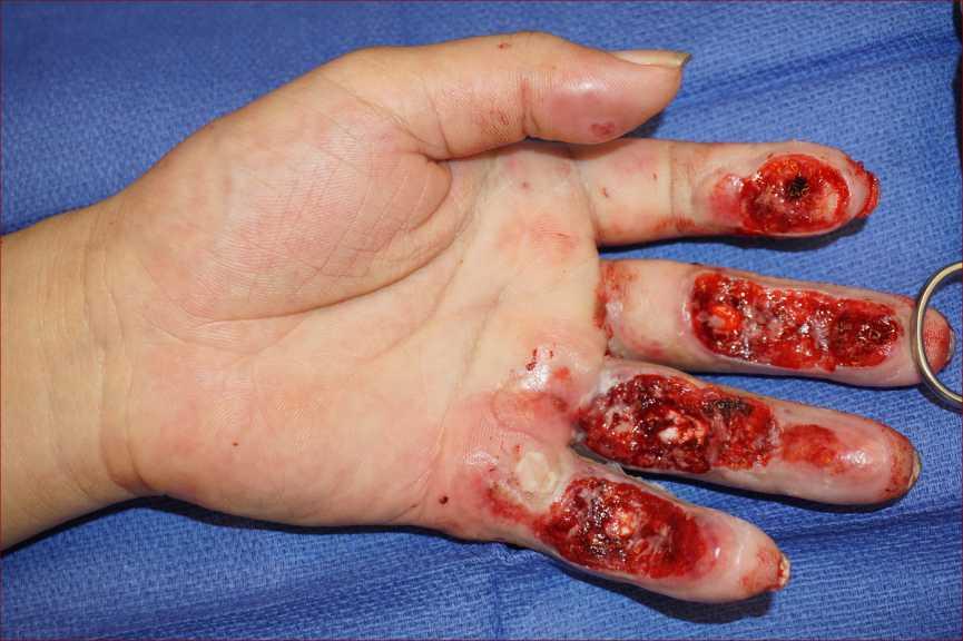 Debrided wounds Volar L hand intraoperative s/p