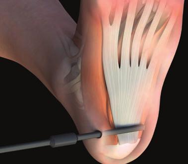 Plantar Fascia Release [1] Palpate the medial plantar calcaneal tubercle and make an incision 1-3mm distal and approximately 17mm above the plantar heel fat pad.
