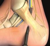 Follow course of pain in pre-op or anatomic course of tibial nerve. [2] Insert elevator under the flexor retinaculum and palpate the proximal edge.
