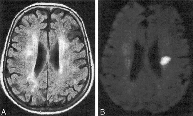 80 ROVIRA AJNR: 23, January 2002 FIG 4. Axial MR images obtained 4 hours after onset of symptoms in a 65-year-old woman with sudden-onset left-sided pure motor hemiparesis lasting 6 hours.