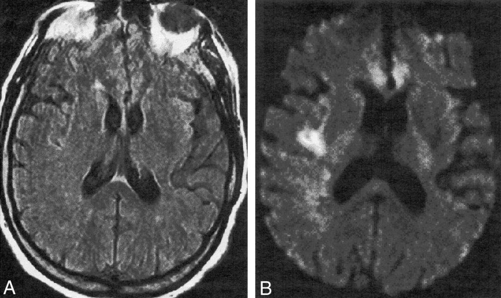 Axial MR images obtained in a 75-year-old man with transient left hemiparesis. A, Fast-FLAIR T2-weighted MR image shows multiple focal lesions in the subcortical white matter.