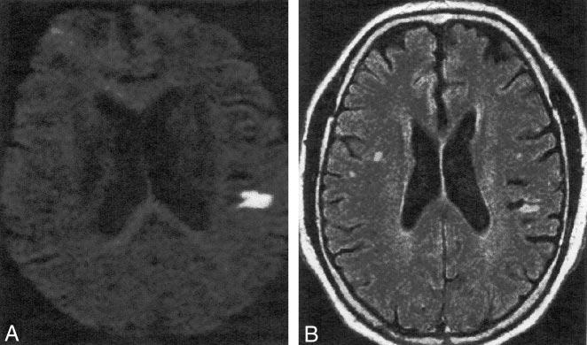AJNR: 23, January 2002 CEREBRAL ISCHEMIA 81 FIG 6. Axial MR images obtained 3 days after symptom onset in a 75-year-old man with left hemiparesis that rapidly resolved within 4 hours of onset.