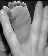 The infant's heel is in the examiner's hand second webspace; the medial foot rests against the index finger and the lateral foot rests against the middle finger; Observe if the forefoot deviates away