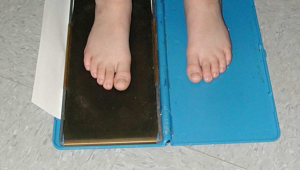 Forefoot Alignment Assessment and Classification of MA Forefoot alignment is determined by the projection of the long axis of the foot In infants, visual estimation of the long axis of the foot can