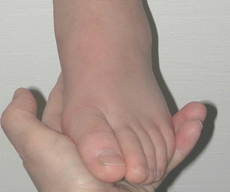 Marking Then, with the foot held in neutral position, the medial malleolus is held between the thumb and index finger and the center point is marked. (Fig. 4.46).