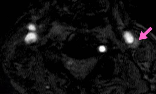 resonance imaging; CCA = common carotid artery.