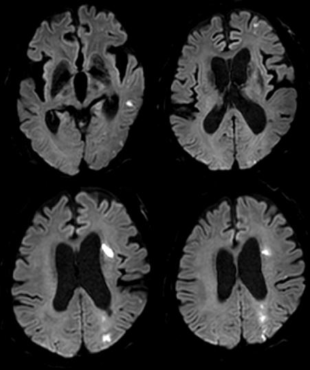PLAQUE MRI IDENTIFYING HIGH-RISK CAROTID STENOSIS in the left ICA (Fig. 6). He was treated with medications. After 27 months, he had a recurrent ischemic cerebrovascular event, amaurosis fugax.