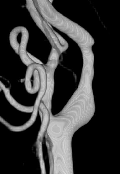 JINSEONG LEE ET AL Fig. 5. Right CCA 3D angiogram shows mild stenosis of right ICA.