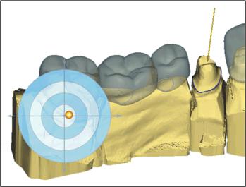 8 Design examples Sirona Dental Systems GmbH 8.5 Attachments Define Insertion Axis Defining the insertion axis Define the axis for all teeth individually in the step "Define Insertion Axis". 8.5.9 Adjusting parameters Instructions The step "Restoration Parameters" is active.