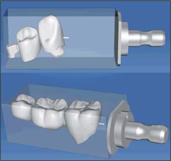 The overlying tooth element is then adapted so that it can be slid onto the attachment. 8.5.11 Grinding the restoration Perform the following steps for both bridges. Instructions 1.
