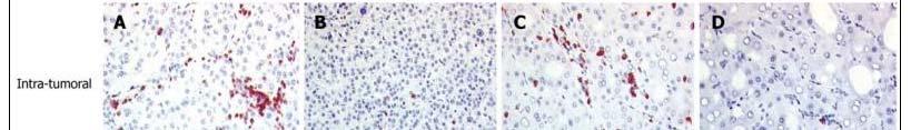 Tumor infiltrating lymphocytes (TILs) TILs are evaluated in 1. Hematoxylin and Eosin stained tissue sections 2.