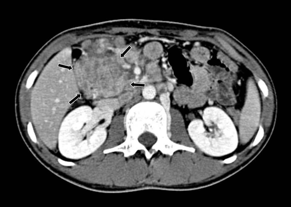 Se Woong Lim et al Contrast-enhanced pancreas CT scan (Fig.