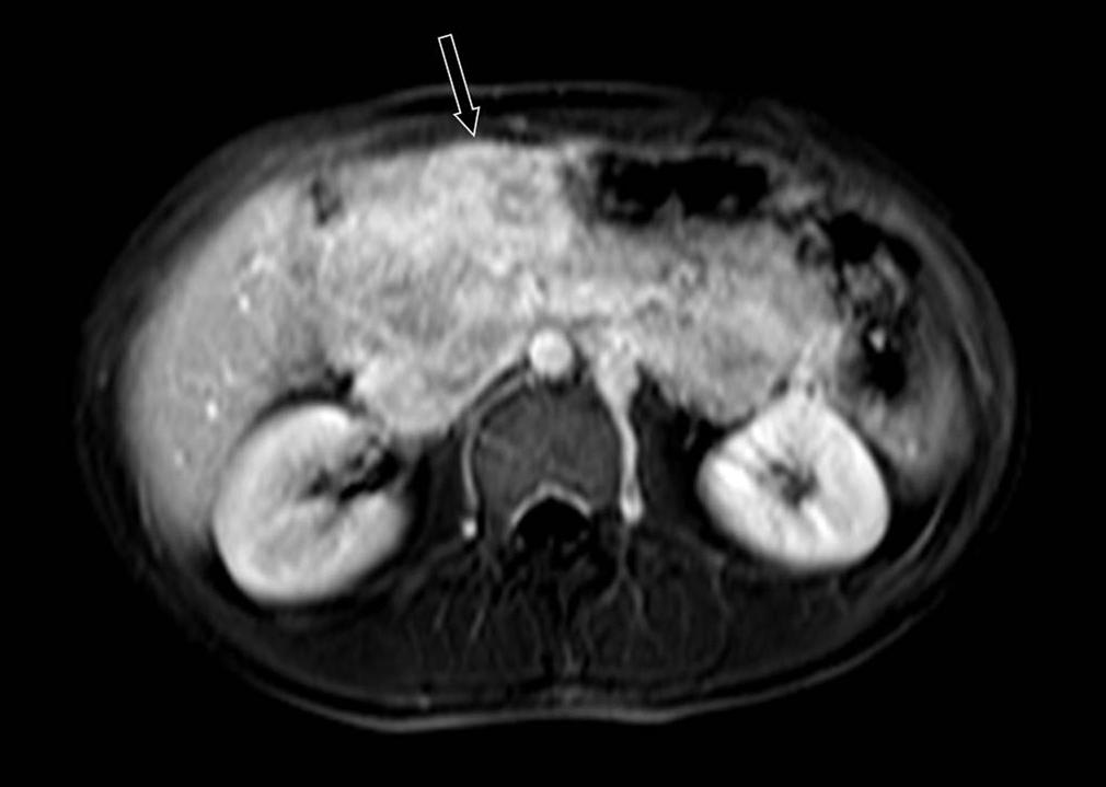 (b) The axial T2-weighted MR image obtained at the same level as in A, depicts a multilobulated mass with heterogeneous