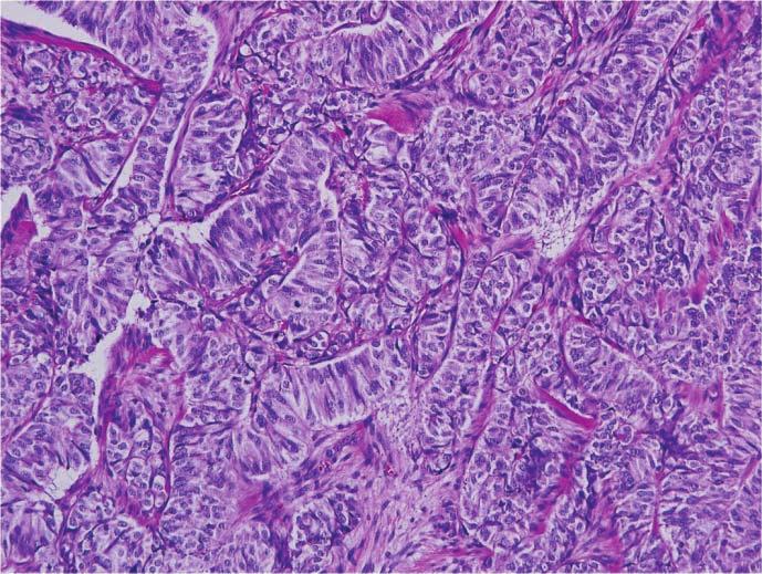 Non-Functioning, Malignant Pancreatic Neuroendocrine Tumor in a 16-Year-old Boy For further evaluation of the pancreatic mass, vascular invasion and bile