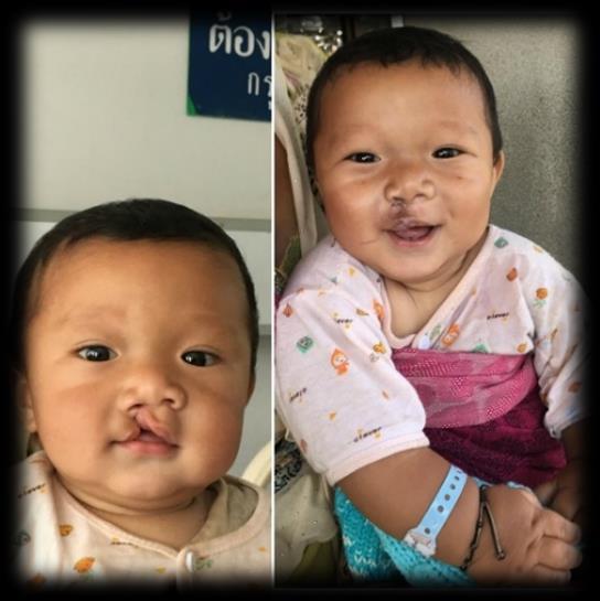 He was born with a cleft lip and a cleft palate. When he turned three years old, his parents planned to have their son undergo surgery.