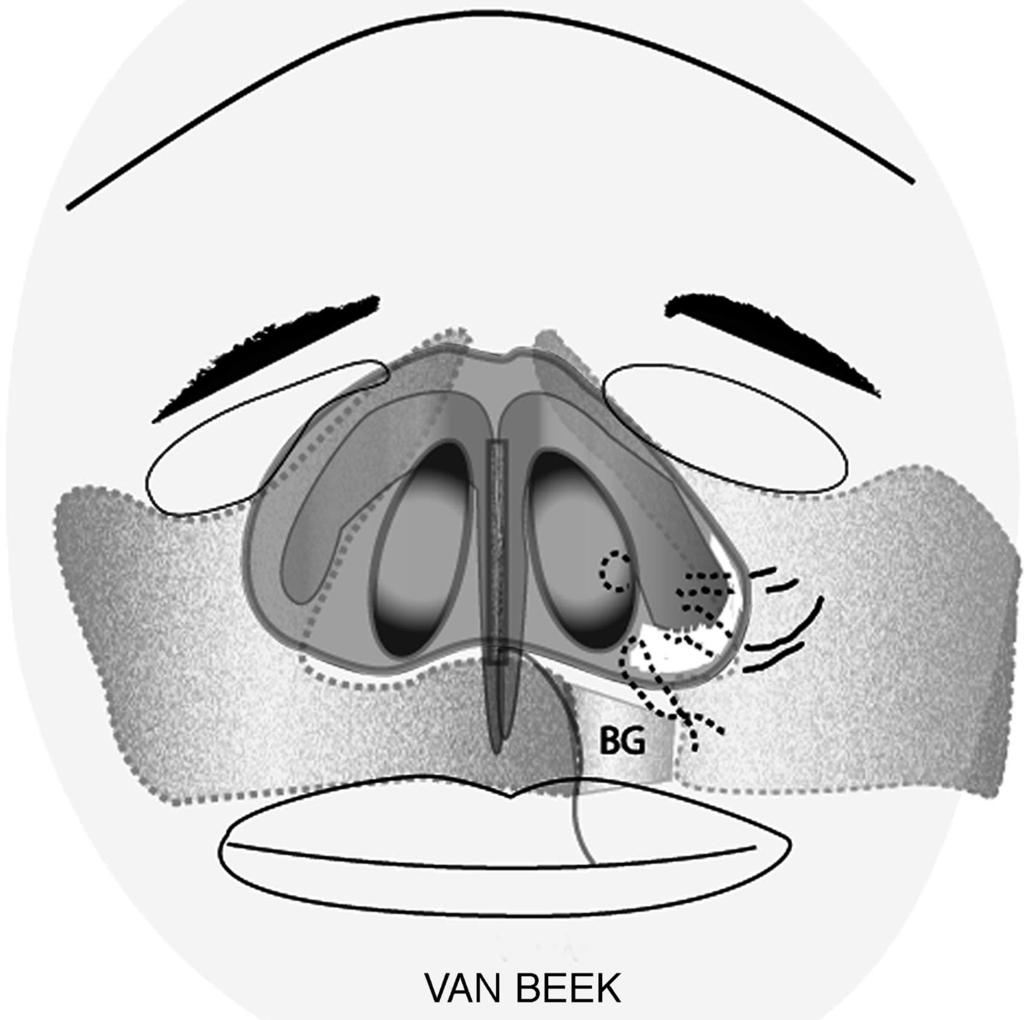 Vol. 114, No. 4 / CLEFT RHINOPLASTY FIG. 27. Three-dimensional illustration of the authors preferred technique for maintaining lateral vestibule volume and shape. BG, bone graft.