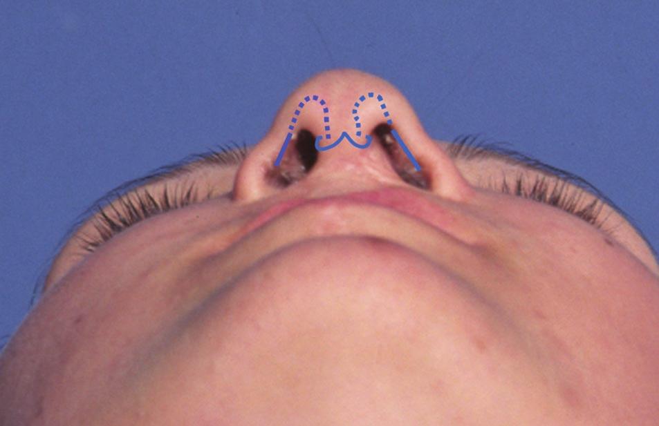 In severe bilateral cleft nasal deformity, the nasal dorsum and columella are short with a very obtuse nasal labial angle.