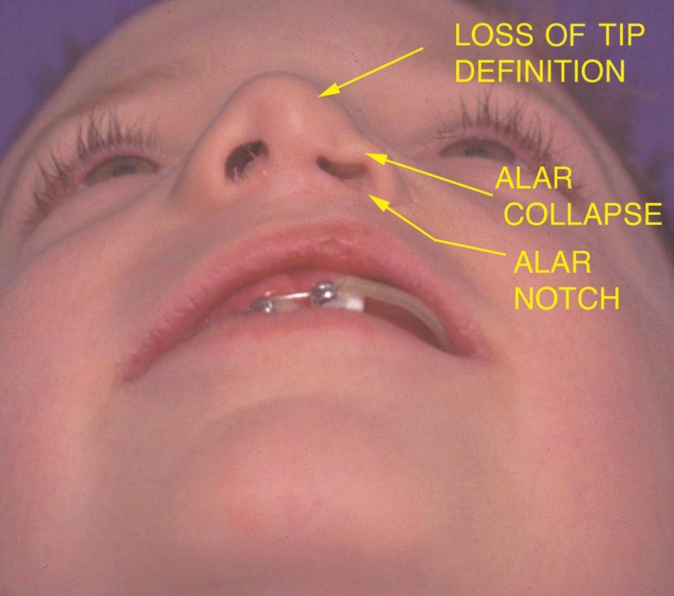Vol. 114, No. 4 / CLEFT RHINOPLASTY 59e FIG. 4. Inferior view of a 6-year-old patient with lower lateral cartilage collapse associated with cleft nasal deformity. FIG. 6. Diagram for documenting abnormalities, sketch planning, and educating patients and parents.