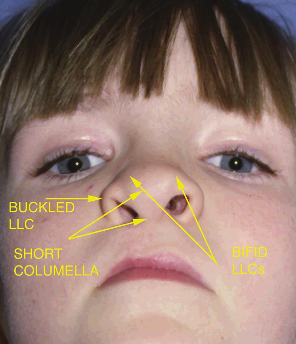 An increase may occur because of a buckle or notch effect on the lower lateral cartilage from primary rhinoplasty adjustment of the nose or if lower lateral cartilage is not modified during the acute