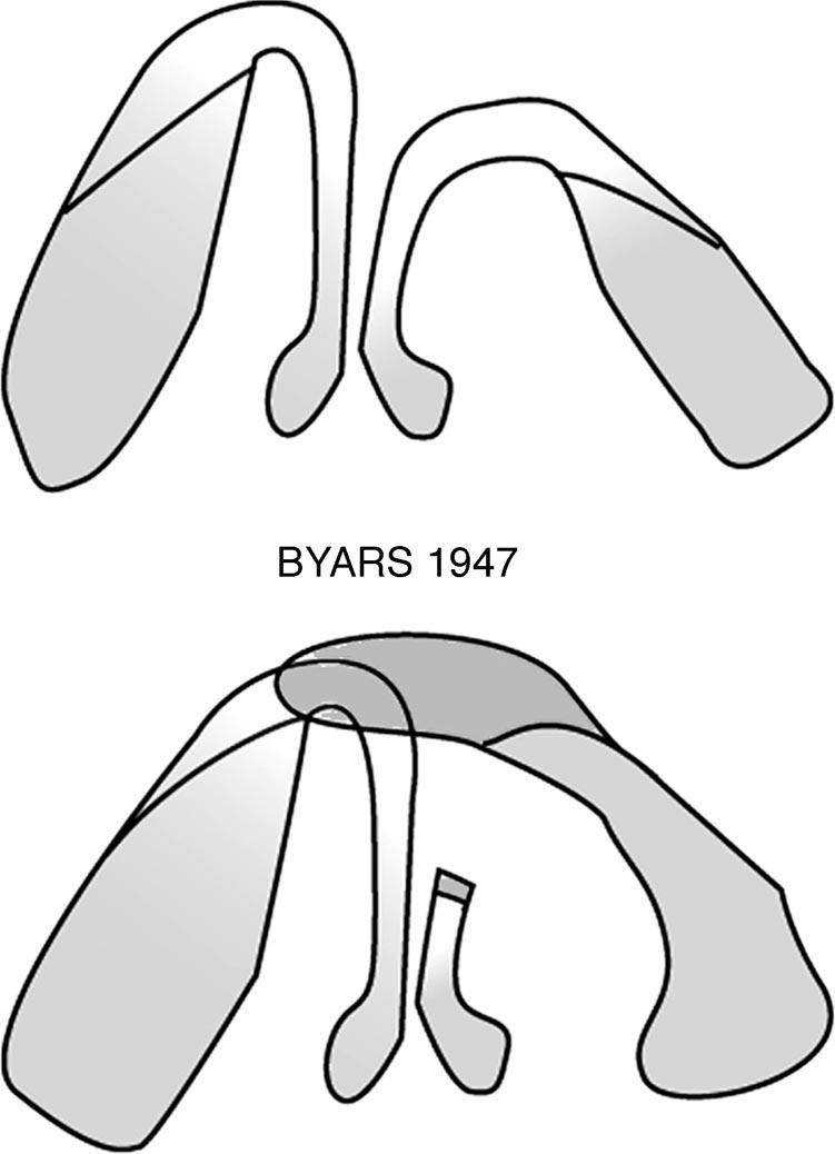 62e PLASTIC AND RECONSTRUCTIVE SURGERY, September 15, 2004 FIG. 14. Byars divided the ipsilateral medial crus and used it to elevate the lower lateral cartilage.