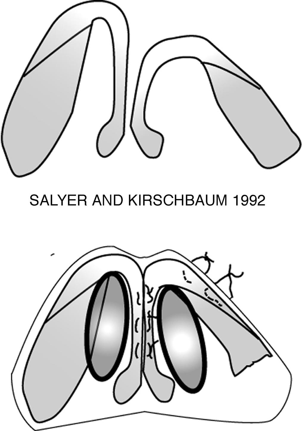 Vol. 114, No. 4 / CLEFT RHINOPLASTY FIG. 23. Salyer and Kirschbaum both advocated early intervention with alteration of lower lateral cartilage position.