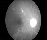 Comparative Study on Localization of Optic Disc from RGB Fundus Images Mohammed Shafeeq Ahmed 1, Dr. B.