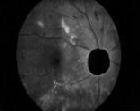 Optic Disc Segmentation Segmentation of optic disc (OD) is a very important step in exudates detection.