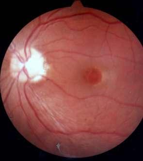 Serous detachment & retinoschisis,cystic macula FLUOROGRAPHIC FEATURES Early hypofluorescence Late