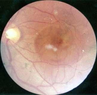 DIFFERENTIAL DIAGNOSIS Central serous retinopathy Macular hole with