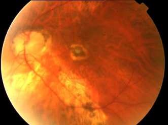 A misdiagnosed case of optic disc pit