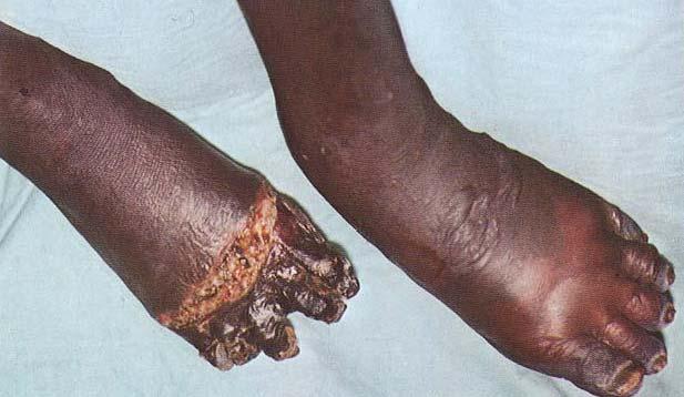 Circulatory damage leads to gangrene of feet and hands* High fevers, mortality