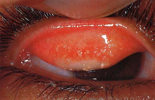 of water, flies, crowding Clinical features: chronic conjunctivitis, scarring,