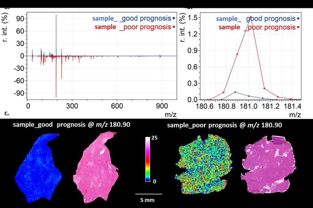 Biomarker Discovery in High Grade Sarcomas by Mass Spectrometry Imaging images from MALDI-TOF and MALDI-FTICR for m/z 241
