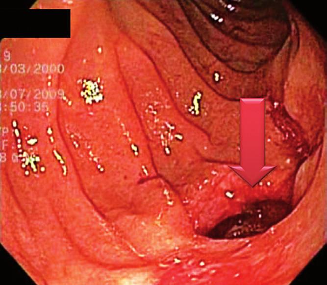 An abdominal CT scan showed distal stent migration resulting in contralateral perforation of the duodenal wall. Intra-abdominal gas (Figure 7) was also observed.