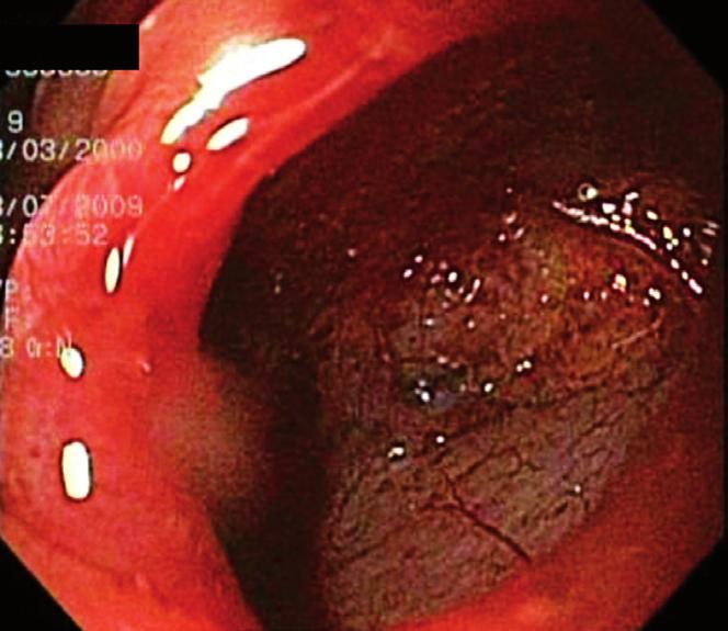 Note the hole in the wall that allows a view of the retroperitoneum after a precut was performed.