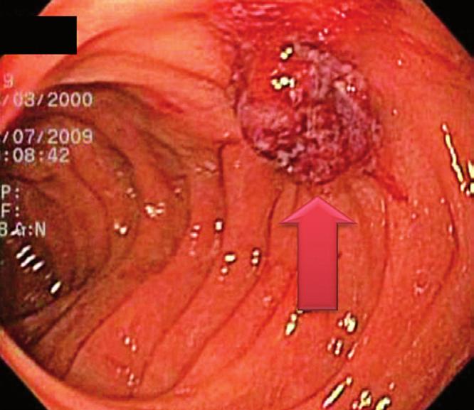 Figure 4. Pseudopolyp formed after repairing the lesion with band ligation. No active bleeding was found and the lesion was corrected in its entirety. Figure 6.