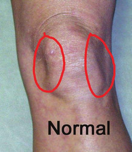 Figure 4: Normal appearance of a knee. The knee skin depressions adjacent to the patella are the knee dimples which disappear with the development of intraarticular swelling (effusion).