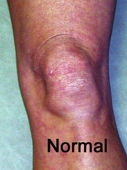 The importance of distinguishing the effusion from the bursitis is that an effusion represents a significant intra-articular disorder, requiring a more thorough examination and treatment regimen.