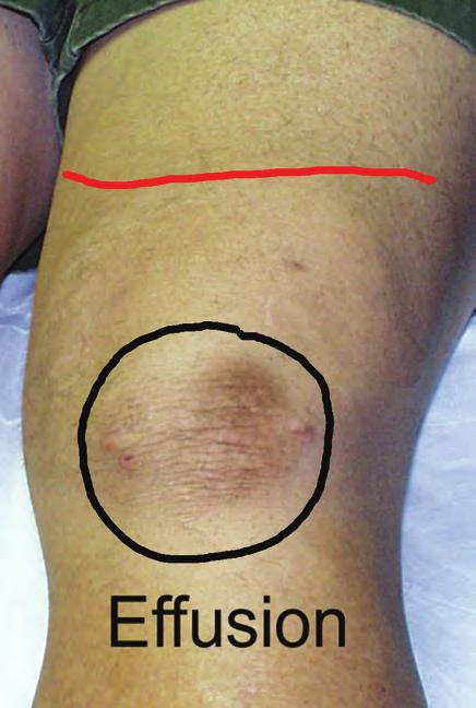 Since an effusion represents an accumulation of fluid inside the joint, as the joint becomes swollen (distended), the dimples on each side of the kneecap will disappear.