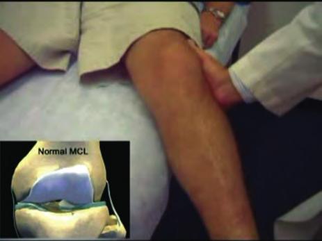 Figure 10: Lateral deforming blow resulting in a torn medial collateral ligament: When examining collateral ligaments, it is necessary to perform