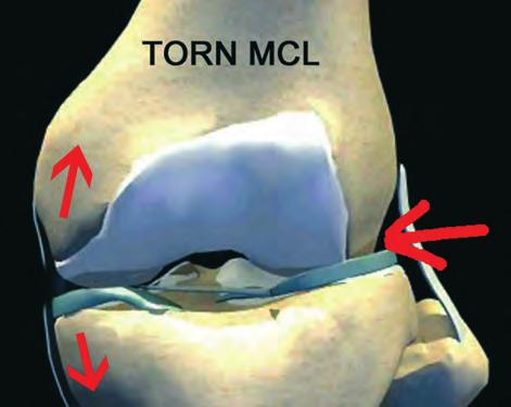 Figure 11: Stabilize the distal femur with one hand and apply a valgus force to the ankle to stress the medial collateral ligament.