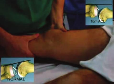 Torn ACL Intact ACL Figure 16: Lachman test. Insets show the anterior subluxation of the tibia, relative to the femur, when the ACL is torn.