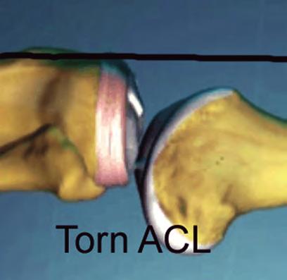 Notice how the anterior aspect of the tibia lines up with the anterior aspect of the femur on lateral examination when the ACL is intact. femur stabilized.