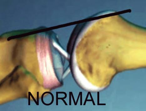 When performing the anterior drawer test (Figure 19), the knee is flexed to 90 degrees.