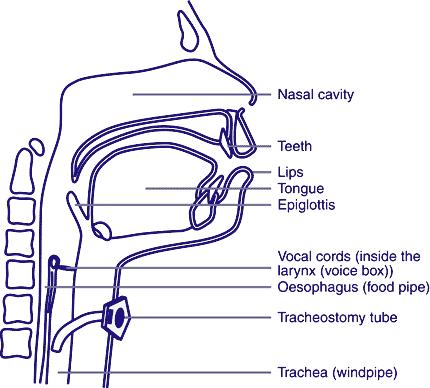 Tracheostomy Insertion of a