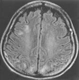 Posterior reversible encephalopathy syndrome A B C D E Figure 2.