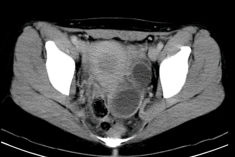 FIGURE 2. Computed tomography exhibiting an oval cystic mass of approximately 16 6 cm in the left retrovesical space adjacent to the bladder.