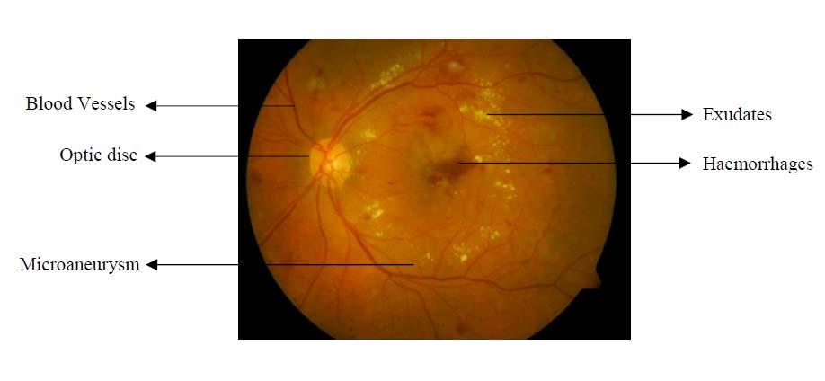 Early detection and Multistage classification of Diabetic Retinopathy using Random Forest Classifier Deepthi K Prasad Full time research scholar, Department of CSE B N M Institute of Technology,